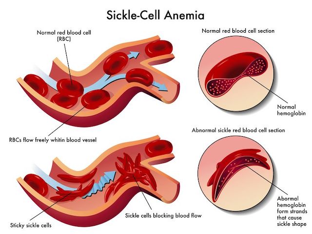 sickle-cell-trait