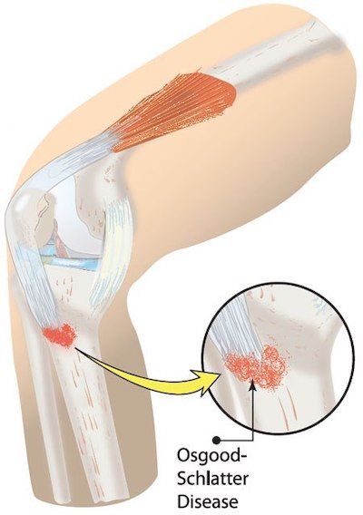 osgood-schlatter-disease