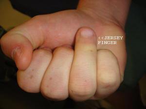 jersey-finger