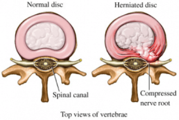 low-back-hernia