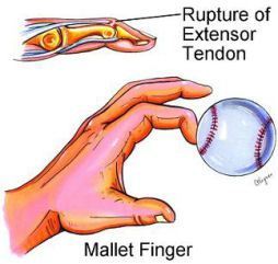 mallet-finger