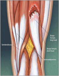 hamstring-strain