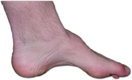 high-arch-foot