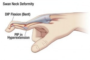 swan-neck-deformity