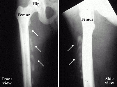 femur-xray