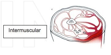 intermuscular