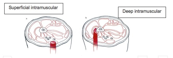 intraularmusc