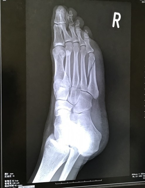 foot-xray